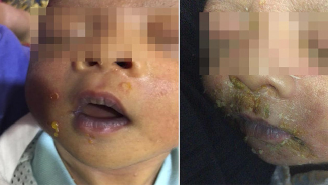 Dicium Kerabat Orangtua, Wajah dan Tubuh Bayi Ini Melepuh