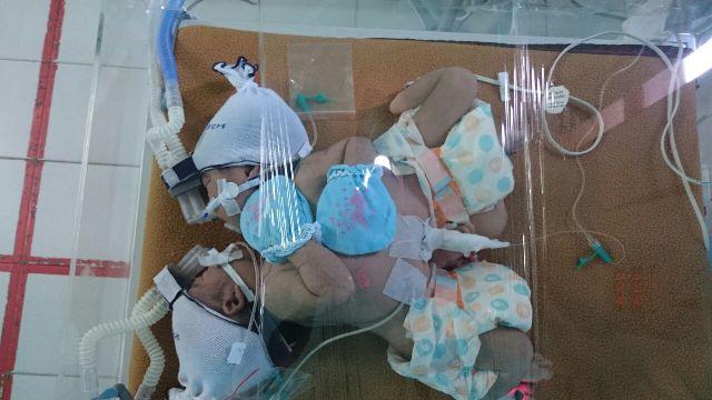 Ibu Muda di Batam Lahirkan Bayi Kembar Siam. Kondisi Bayinya Memprihatinkan