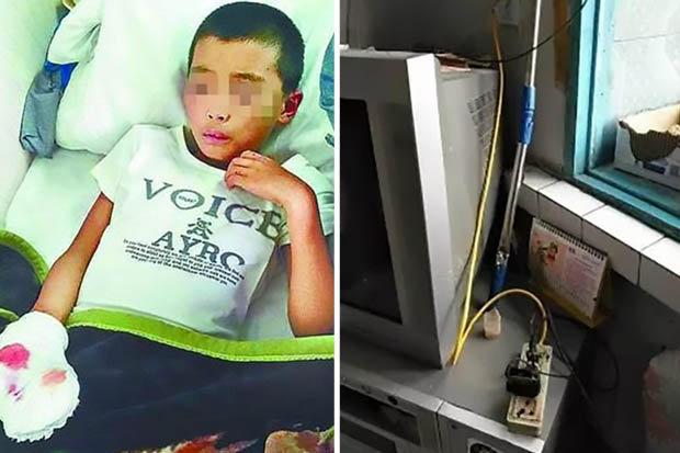 Charger Ponsel Meledak, 4 Jari Bocah Ini Putus 
