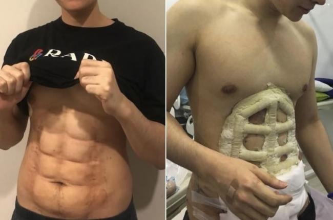 Duh, Oplas Perut Sixpack di Thailand: Bukan Pakai Silikon Tapi Diukir