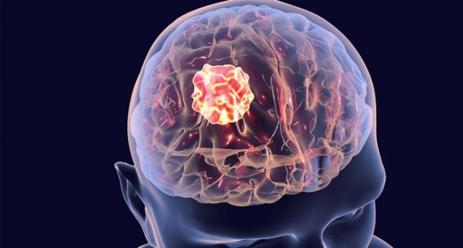 Kenali Penyebab Kanker Otak yang Muncul untuk Temukan Cara Mengatasinya