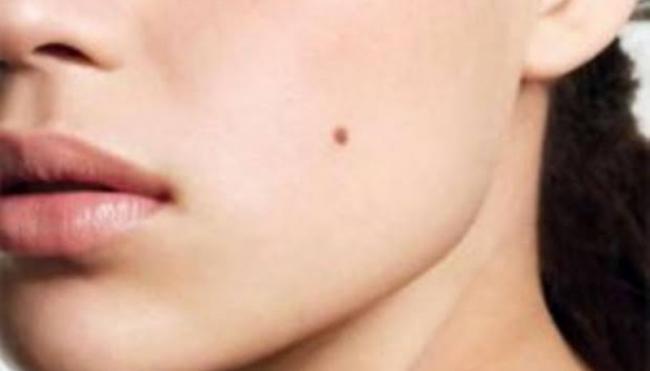 Kenali Basal Cell Carcinoma, Kanker Kulit Ganas yang Mirip Tahi Lalat