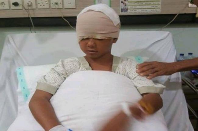 Gadis Lingga Korban Kulit Kepala Terkelupas Segera Jalani Operasi Kedua