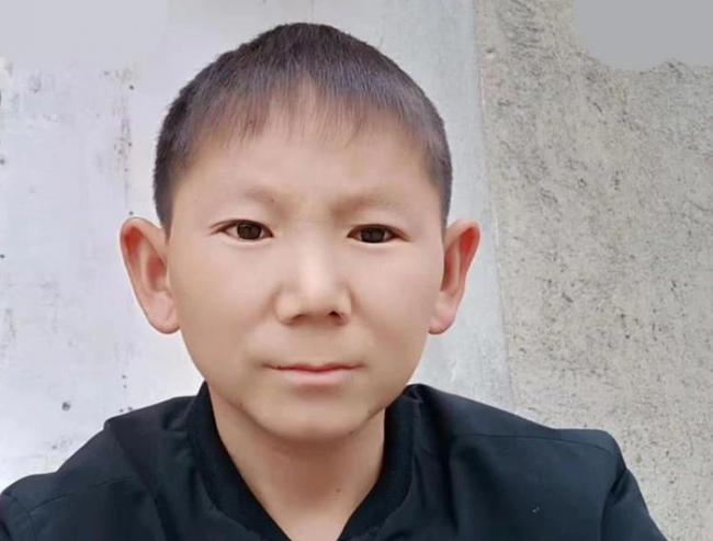 Cedera Kepala Saat Kecil Bikin Pria 34 Tahun Jadi Berwajah Anak-anak