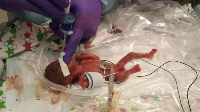 Saybie, Bayi Terkecil di Dunia Berbobot 8,6 Ons