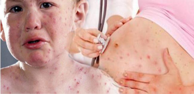  Ibu Hamil 4 Kali Keguguran Akibat Rubella di Tanjungpinang