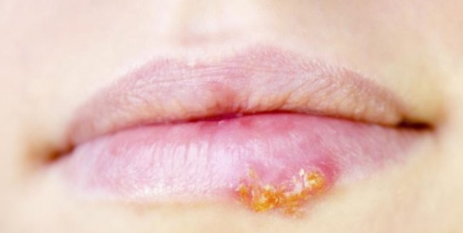 6 Hal Penting yang Perlu Diketahui Tentang Penyakit Herpes