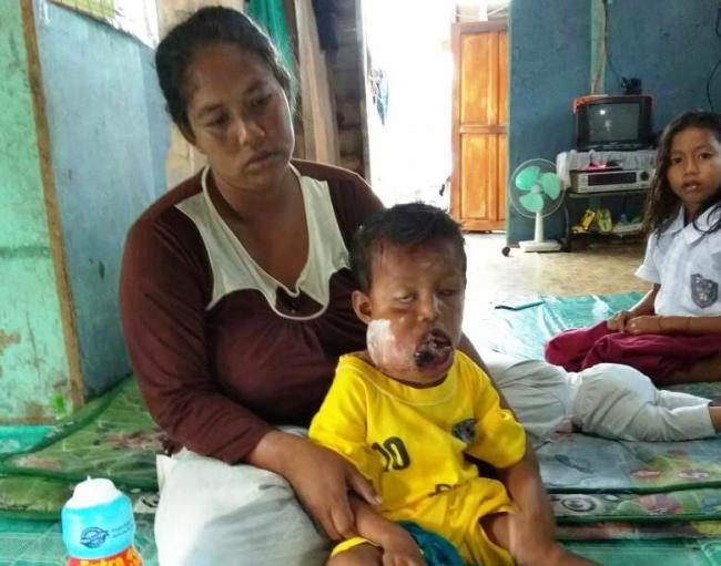 Wakapolda Kepri Jemput Langsung Bocah Penderita Tumor Mulut