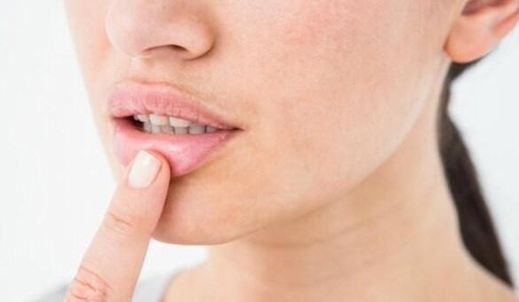 Bibir Pecah-pecah Saat Bangun Tidur? Berikut Cara Mengatasinya