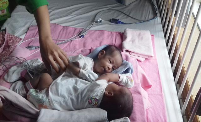 RS Awal Bros Akan Gelar Operasi Pemisahan Kembar Siam Pertama di Kepri