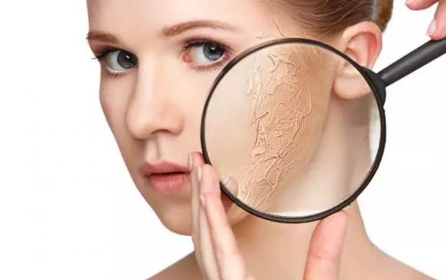 7 Cara Mengatasi Kulit Kering dan Mengelupas