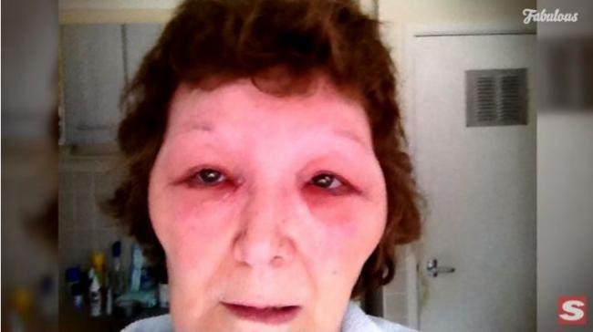 Kisah Wanita Korban Suntik Botox Palsu, Wajahnya Jadi Mirip Frankenstein