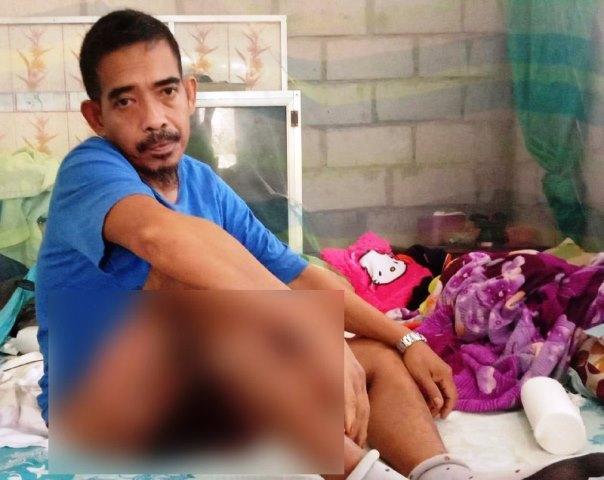FKPS Galang Dana untuk Amsaton, Pria yang Digerogoti Kanker Kulit Ganas di Natuna