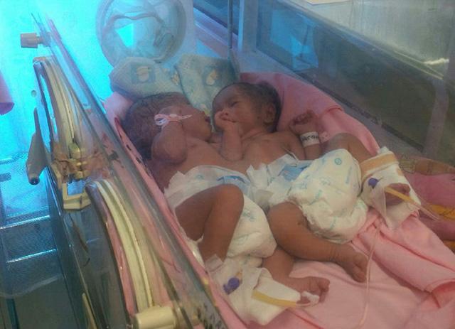 Butuh Bantuan, Dua Bayi Cantik di Batam Ini Dempet di Bagian Tubuh