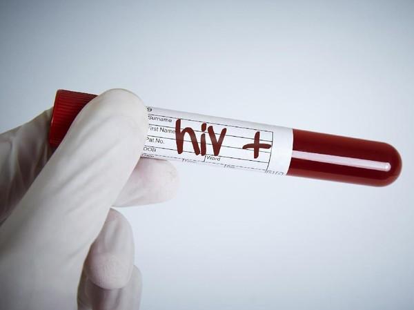 Pria Meninggal karena AIDS, 40 Wanita yang Dipacari Shock