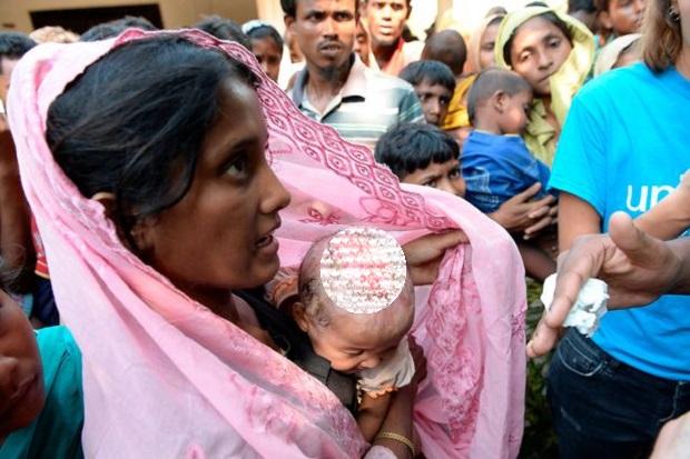Bayi Rohingya 18 Bulan Trauma Kena Ledakan Bom Myanmar