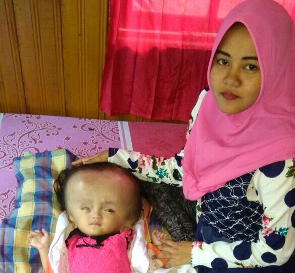 Pasangan Muda ini Berharap Bayinya Sembuh dari Hidrosefalus