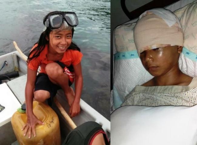 Mencekam, Saat Kulit Kepala Anita Terkuliti Baling-baling Perahu