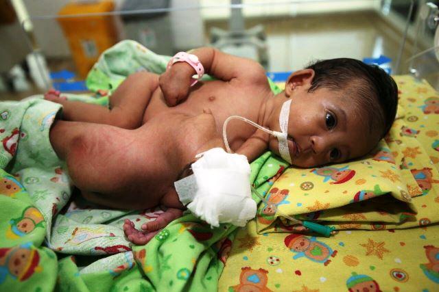Operasi Kembar Siam di RSBP Batam Hanya Bisa Selamatkan Satu Bayi