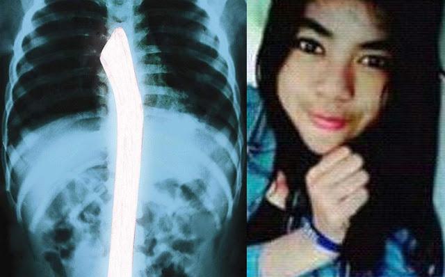 Kasus Enno Dibunuh Pakai Cangkul Termasuk Tersadis, ini Hasil Rontgennya 