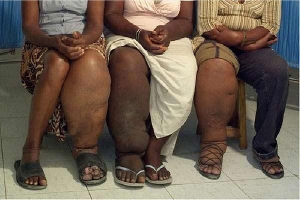 Ini Efek Samping Minum Obat Anti Kaki Gajah