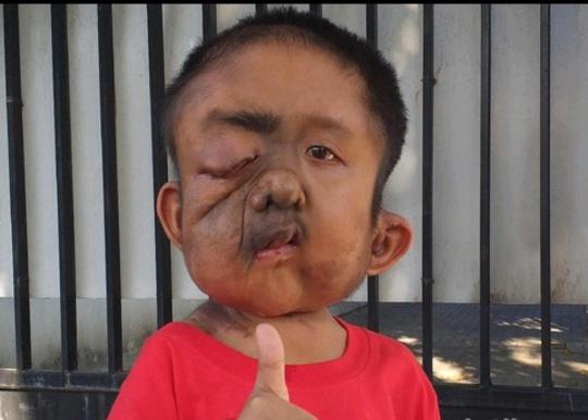 Kasihan, Bocah Yatim Piatu Ini Idap Empat Jenis Tumor dan Kanker Sekaligus