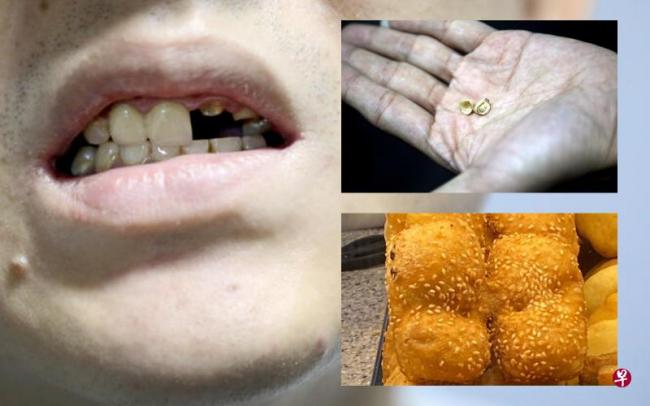 Kerikil dalam Sepotong Roti Bikin Pria Singapura Kehilangan Dua Gigi