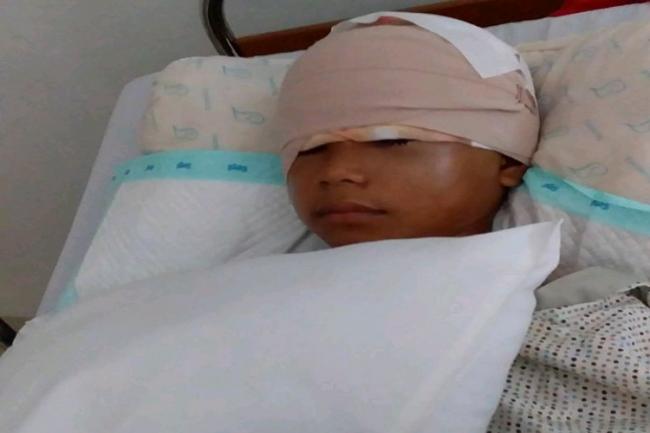 Anita Korban Kulit Kepala Terkelupas Bakal Jalani 4-5 Kali Operasi