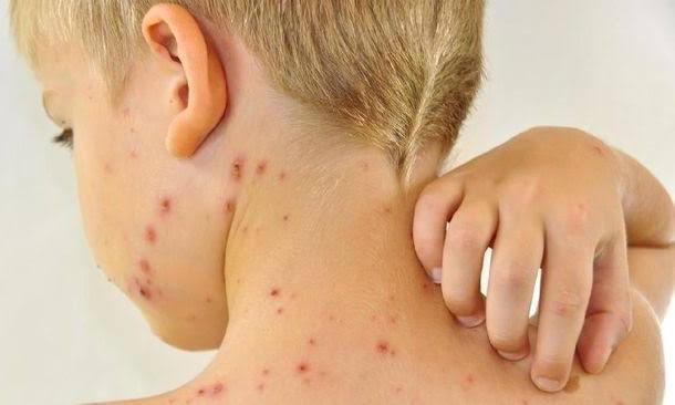 Bebas dari Ebola, Kongo Kini Dilanda Wabah Cacar Monyet