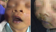 Dicium Kerabat Orangtua, Wajah dan Tubuh Bayi Ini Melepuh