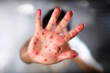 WHO Sebut Lebih 110.000 Orang Meninggal Karena Campak dan Rubella