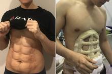 Duh, Oplas Perut Sixpack di Thailand: Bukan Pakai Silikon Tapi Diukir