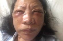Heboh Ratna Sarumpaet, Begini Lho Proses Penyembuhan Luka Oplas