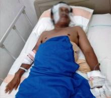Penjual Mie Ayam Tersambar Api, Wajah dan Tangannya Melepuh