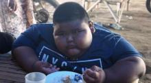 Satia, Bocah 7 Tahun Berbobot 101 Kg Meninggal Dunia