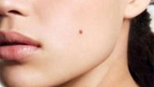 Kenali Basal Cell Carcinoma, Kanker Kulit Ganas yang Mirip Tahi Lalat