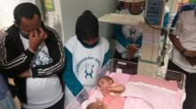 Akhirnya, Operasi Pemisahan Bayi Kembar Siam Rahma-Rahmi Sukses