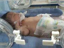 Polda Kepri Bantu Pengobatan Bayi Penderita Infeksi Usus Asal Karimun