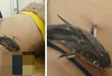 Hati-hati Berenang di Laut, Perut Wanita Ini Disengat Sirip Ikan hingga Nempel