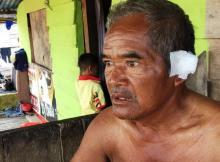 Telinga Tukang Parkir di Karimun Nyaris Putus Ditebas Begal
