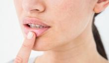 Bibir Pecah-pecah Saat Bangun Tidur? Berikut Cara Mengatasinya
