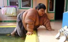 Arya, Bocah 10 Tahun dengan Berat 190 Kilogram Dilarikan ke Rumah Sakit