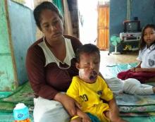 Ganasnya Tumor Gigi yang Diderita Bocah Asal Moro Ini