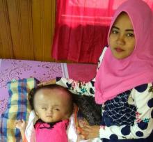 Pasangan Muda ini Berharap Bayinya Sembuh dari Hidrosefalus