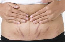 Stretch Mark Bisa Dihilangkan, Ini Tipsnya