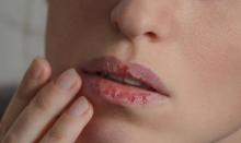 Bibir Kering dan Pecah-pecah Diwaspadai Jadi Gejala Baru Infeksi Corona