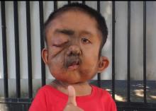 Kasihan, Bocah Yatim Piatu Ini Idap Empat Jenis Tumor dan Kanker Sekaligus