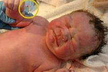 Foto Bayi Perkasa, Lahir ke Dunia Sambil Genggam Kontrasepsi Spiral