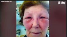 Suntik Botox Sembarangan, Wajah Wanita Inggris Rusak Parah