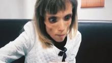 Kristina, Pengidap Anorexia Berbobot Tubuh Cuma 17 Kg